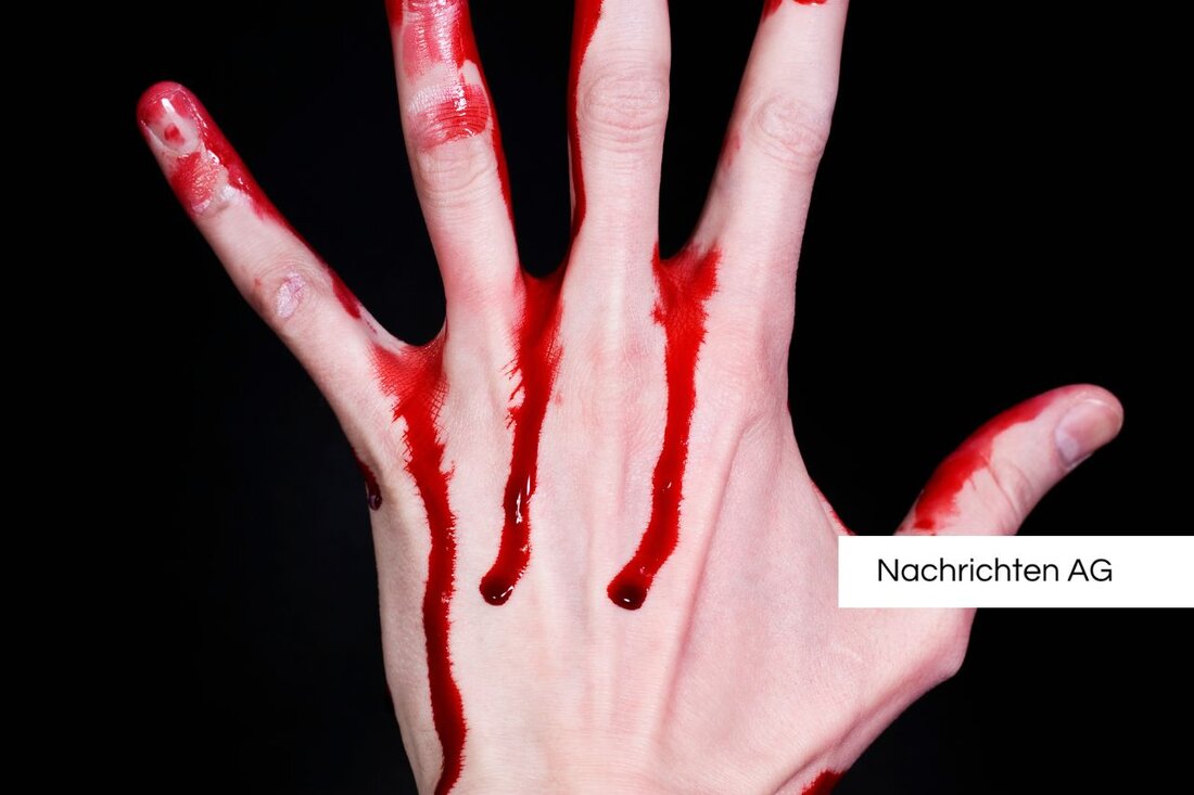 Große blaue Flecken nach leichten Stößen können ein Zeichen für Hämophilie sein. Erfahren Sie mehr über die Erkrankung und ihre Symptome in unserem aktuellen Artikel.