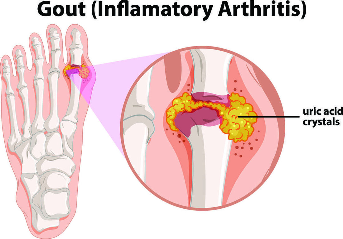 Gelenkschmerzen betreffen Millionen von Menschen weltweit, wobei laut CDC allein in den Vereinigten Staaten über 54 Millionen Erwachsene an Arthritis leiden. Gicht, eine Art entzündlicher Arthritis, ist ebenfalls auf dem Vormarsch und betrifft 8,3 Millionen Amerikaner. Für diejenigen, die mit Gelenkschmerzen, Entzündungen oder Gicht zu kämpfen haben, ist es wichtig, Linderung zu finden, um die Lebensqualität zu erhalten. Glücklicherweise können bestimmte Lebensmittel, Kräuter und Gewürze helfen, diese Symptome zu lindern und gleichzeitig die Darmgesundheit zu verbessern. In diesem Artikel untersuchen wir 18 köstliche Lebensmittel, Kräuter und Gewürze, die durch wissenschaftliche Studien gestützt werden, wie Sie sie in Ihr tägliches Leben …