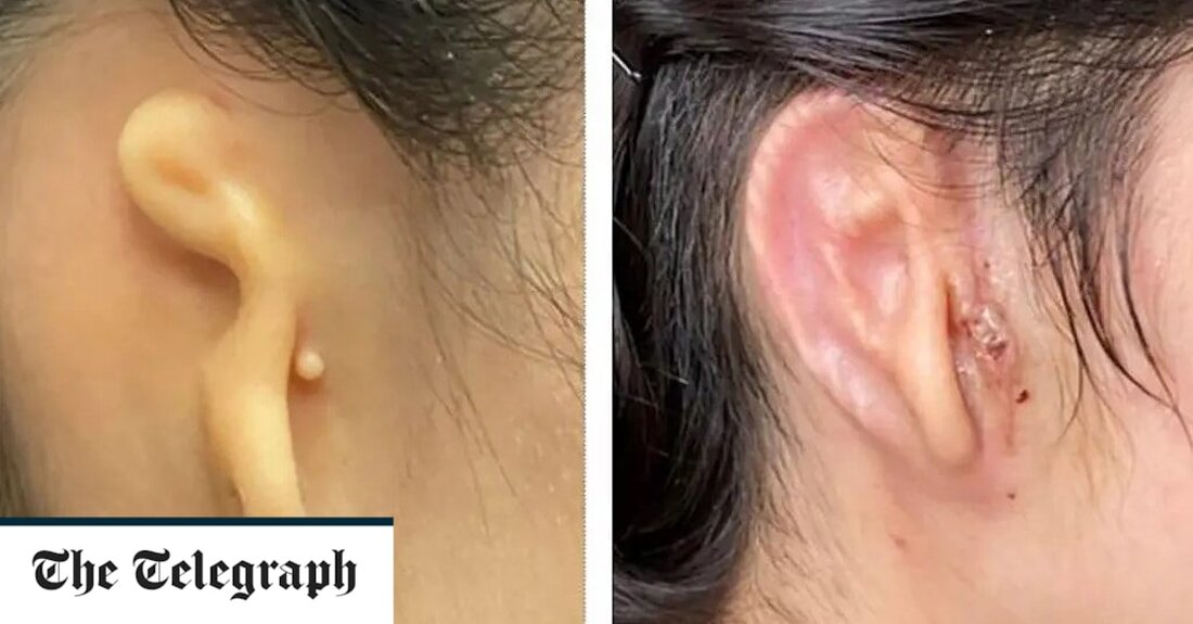 Eine junge Frau hat ein 3D-gedrucktes Ohrimplantat erhalten, das aus ihren eigenen Zellen hergestellt wurde, in einer wissenschaftlichen Entwicklung, die die Medizin „revolutionieren“ könnte. Die 20-Jährige, die mit einer seltenen Missbildung geboren wurde, die ihr rechtes Ohr klein und unförmig machte, wurde im März in den USA einer rekonstruktiven Operation unterzogen – Teil der ersten klinischen Studie, bei der 3D-Druck zur Konstruktion eines lebenden Implantats verwendet wurde Gewebe. „Das ist so aufregend, manchmal muss ich mich ein bisschen zügeln“, sagte Dr. Arturo Bonilla, der die Operation in Texas durchführte, der New York Times. „Wenn alles wie geplant läuft, wird dies &hellip;