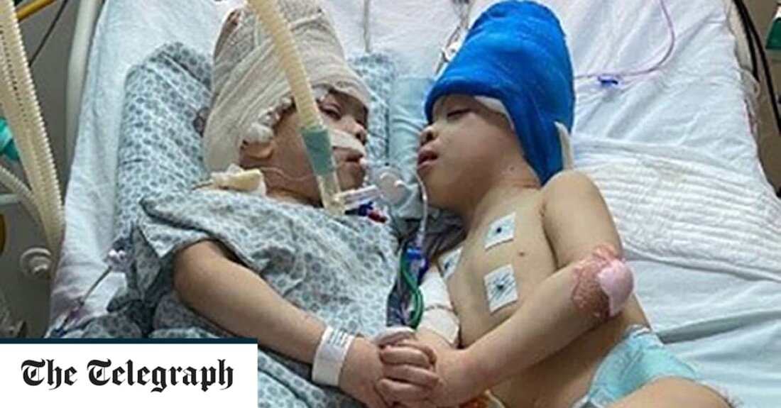 Zwillinge, die am Kopf verbunden waren, wurden mit Hilfe eines Neurochirurgen in der Great Ormond Street in einer 27-Stunden-Operation getrennt. Bernardo und Arthur Lima, die mit verschmolzenen Gehirnen geboren wurden, wurden in Rio de Janeiro unter der Leitung von Noor ul Owase Jeelani, einem in London ansässigen Kinderchirurgen, mehreren Operationen unterzogen. Die Dreijährige hatte insgesamt sieben chirurgische Eingriffe mit mehr als 27 Stunden Operationszeit allein bei der letzten Operation und fast 100 medizinischem Personal. Laut Gemini Untwined, der Wohltätigkeitsorganisation von Herrn Jeelani, war es einer der komplexesten Trennungsprozesse, die jemals durchgeführt wurden. Chirurgen in London und Rio verbrachten Monate damit, &hellip;