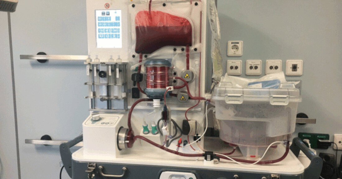 Das neue Gerät ermöglicht die maschinelle Perfusion (Spülung) einer Spenderleber. Mit diesem Gerät können die Experten des Transplantationszentrums des Universitätsklinikums die Organfunktion vor der Transplantation genauer beurteilen und müssen daher weniger Organe abstoßen. Lebertransplantation in der Universitätsklinik Seit über 25 Jahren werden Lebern am Universitätsklinikum Leipzig erfolgreich transplantiert. Ärzte werden zunehmend mit einer abnehmenden Qualität der Spenderorgane konfrontiert. &#8222;Die Spender werden älter und kranker, ebenso wie ihre Lebern&#8220;, erklärt Dr. Sebastian Rademacher, Oberarzt auf dem Gebiet der hepatobiliären Chirurgie und der viszeralen Transplantation. Hinzu kommt, dass Deutschland beim Gebervolumen in Europa die Nase vorn hat. 15 bis 30 Prozent aller &hellip;